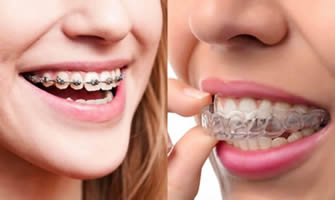 Teeth Alignment in Dhuri Dental Clinic