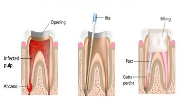 Root canal Treatment in Dhuri Dental Clinic