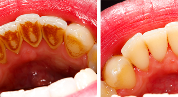 Get white teeth in Dhuri Dental Clinic