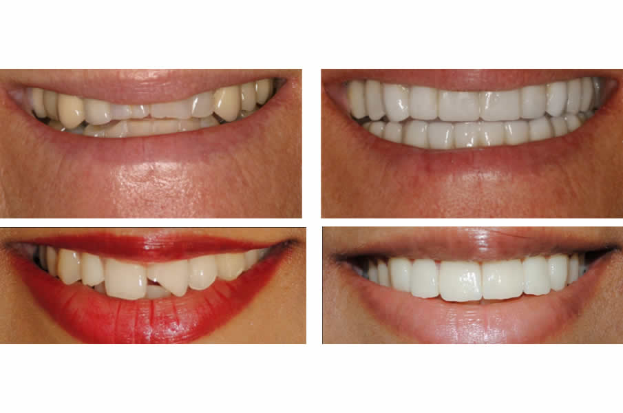 Smile Designing in Dhuri Dental Clinic