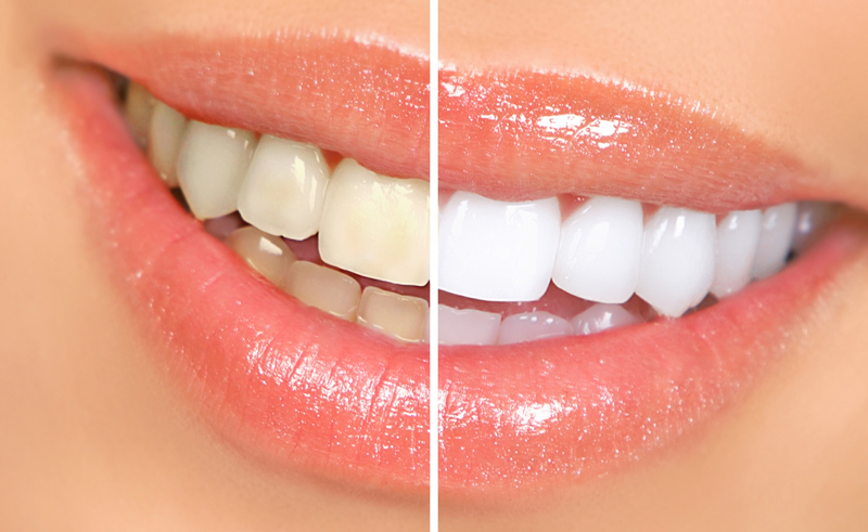 Get White teeth in dental clinic in dhuri